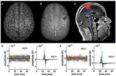 Time-Frequency Representation of Motor Evoked Potentials in Brain Tumor Patients